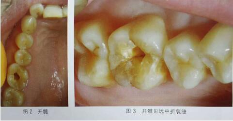 隐裂牙治疗保存——根管治疗后加全瓷冠修复