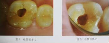 隐裂牙治疗保存——根管治疗后加全瓷冠修复