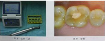 隐裂牙治疗保存——根管治疗后加全瓷冠修复