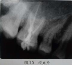 隐裂牙治疗保存——根管治疗后加全瓷冠修复