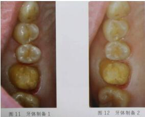 隐裂牙治疗保存——根管治疗后加全瓷冠修复