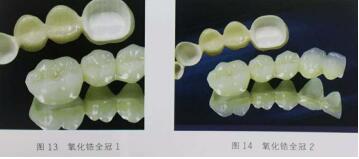 隐裂牙治疗保存——根管治疗后加全瓷冠修复