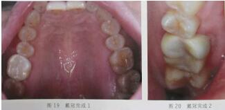 隐裂牙治疗保存——根管治疗后加全瓷冠修复