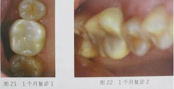 隐裂牙治疗保存——根管治疗后加全瓷冠修复