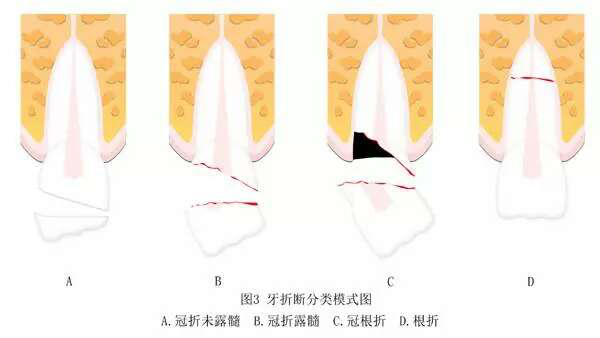 【科普】拔牙与牙外伤