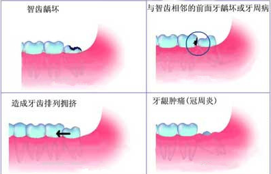 智齿别等疼了再拔