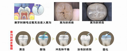 儿童口腔预防保健手册（医疗篇-窝沟封闭）